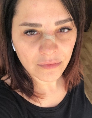 (Özel) Ünlü Şarkıcı Reyhan Karaca’Nın Burnu Kırıldı